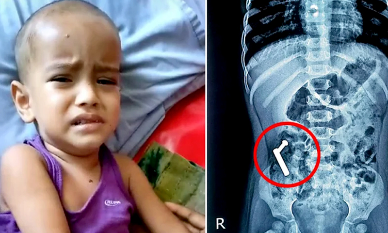 শিশুর খাদ্যনালী কেটে বের করা হলো জানালার ছিটকিনি