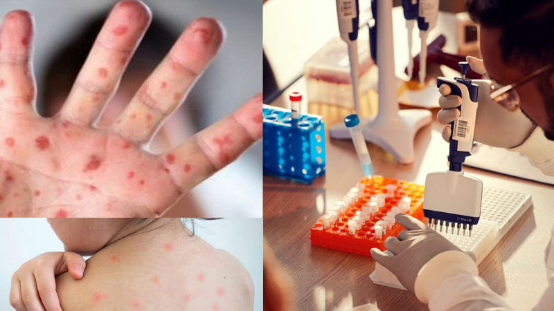 হাম উপসর্গে আরও ৫ শিশুর মৃত্যু